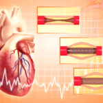 Coronary artery disease