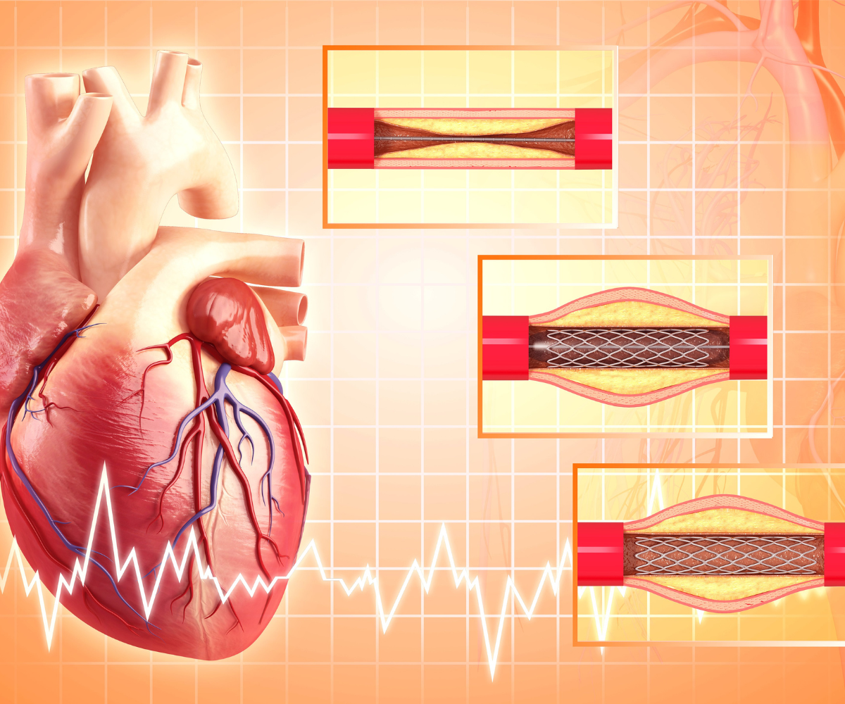 Coronary artery disease