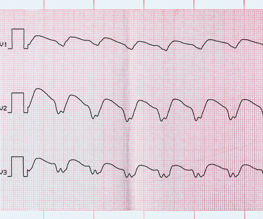 Sinus tachycardia - cardio care heart institute